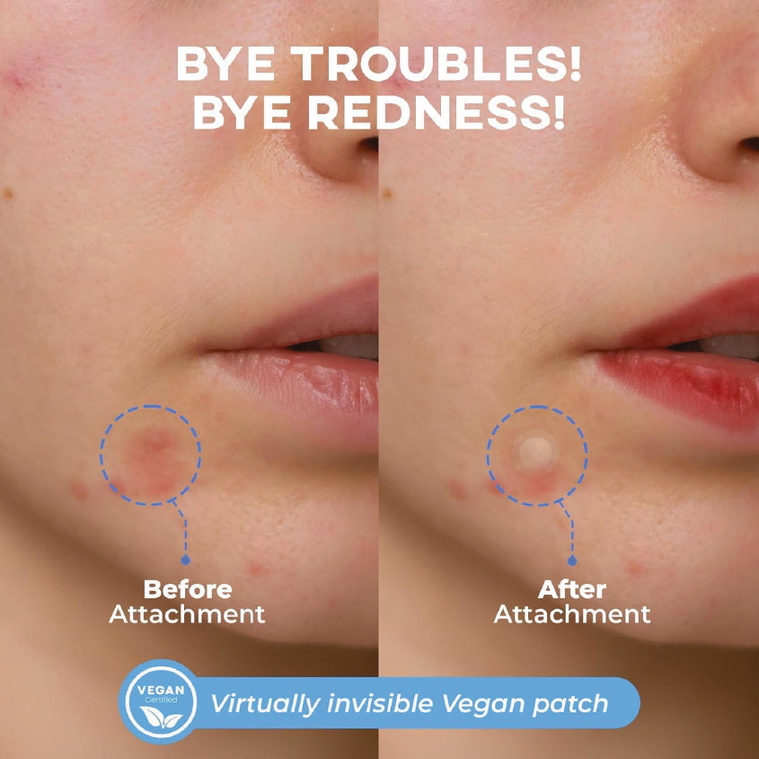 NOLAHOUR Spot Eraser Step 2 (Blue - Invisible + Spot Recovery Stage) 63 Patches