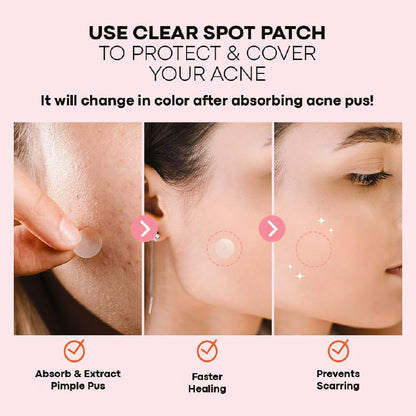 NOLAHOUR Pimple Clear Spot Patch (Treatment, Protects & Covers Acne Scars, Transparent) 26 Patches