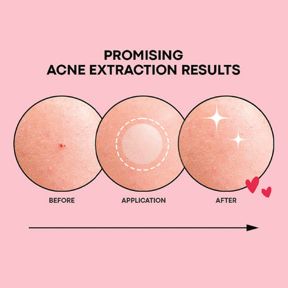 NOLAHOUR Pimple Clear Spot Patch (Treatment, Protects & Covers Acne Scars, Transparent) 26 Patches