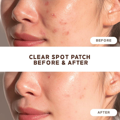NOLAHOUR Pimple Clear Spot Patch (Treatment, Protects & Covers Acne Scars, Transparent) 26 Patches