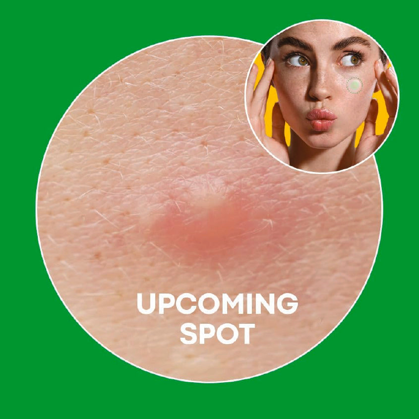 NOLAHOUR Spot Eraser Step 1 (Green - Micropoint for Early-Stage Spot) 9 Patches