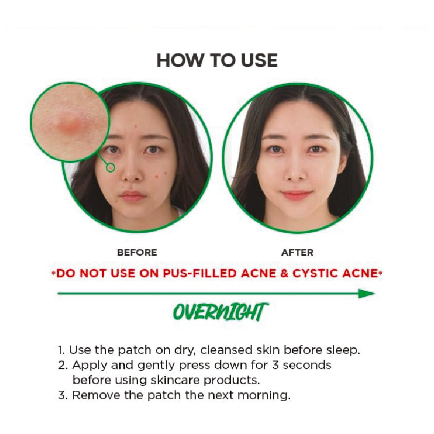 NOLAHOUR Spot Eraser Step 1 (Green - Micropoint for Early-Stage Spot) 9 Patches